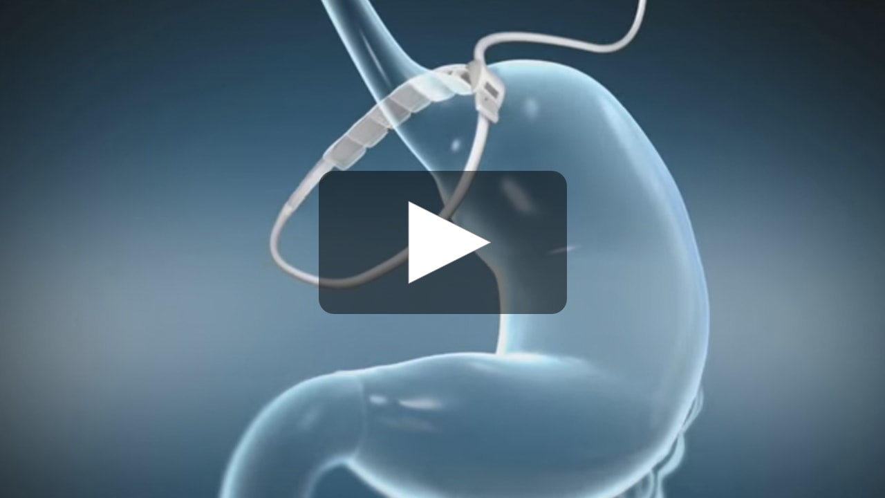NJ Gastric Band Surgery New Jersey Gastric Banding