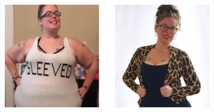 Before & After Sleeve Gastrectomy: Down 153 Pounds! | Advanced